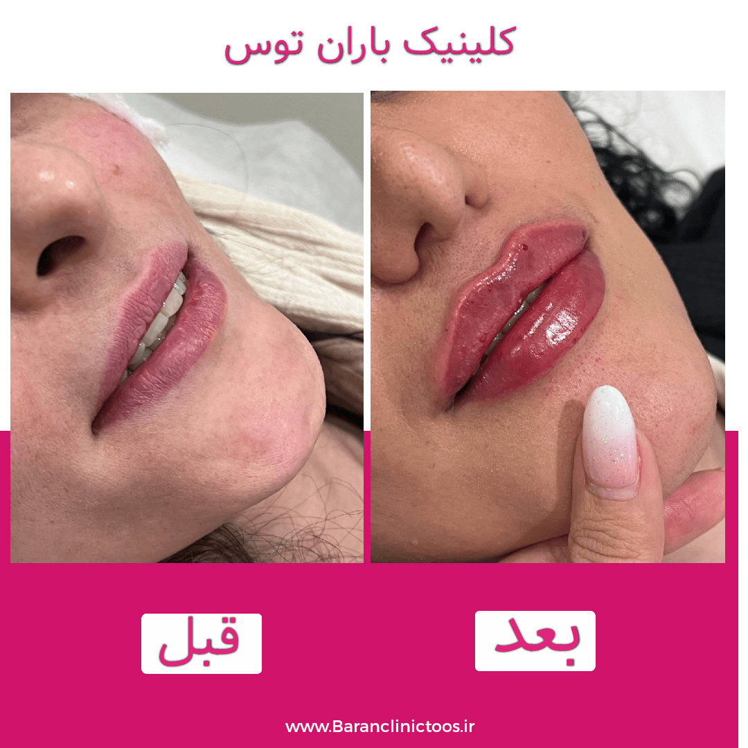 قبل و بعد فیلر لب